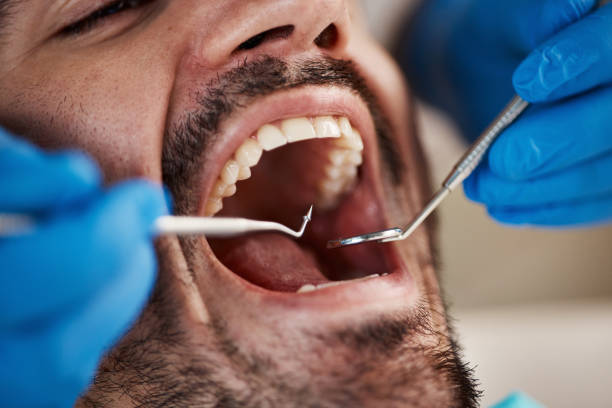 Best Broken Tooth Emergency  in Limesa, CA